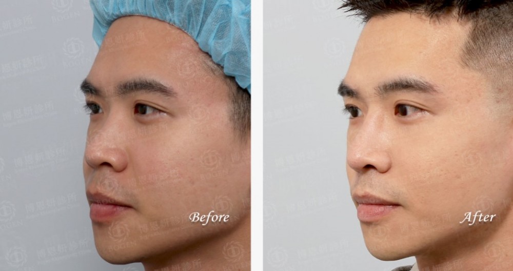 韓式隆鼻,結構式隆鼻,博恩妍